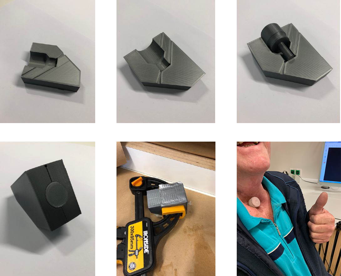 Six photographs showing printed mould parts, assembly around a cannula, a closed and clamped mould, and the finished cannula being worn